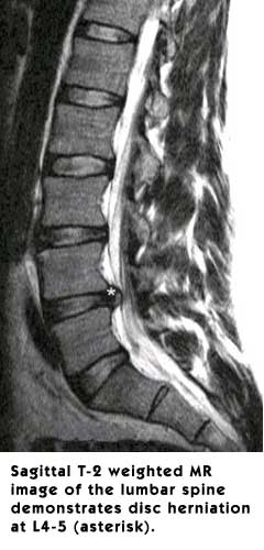 Disc Herniation