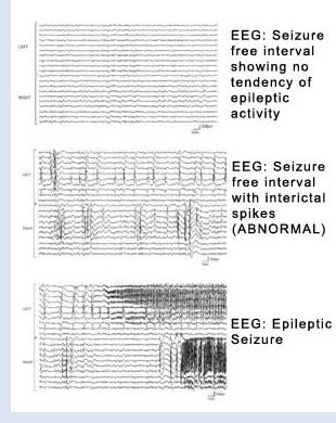 EEG