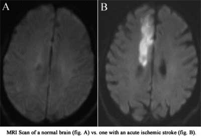 MRI for stroke